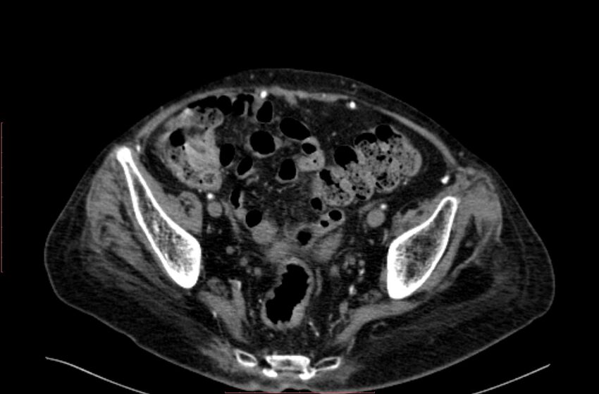 Abdominal aortic interposition tube graft and aneurysm thrombosis (Radiopaedia 71438-81857 Axial C+ arterial phase 195).jpg
