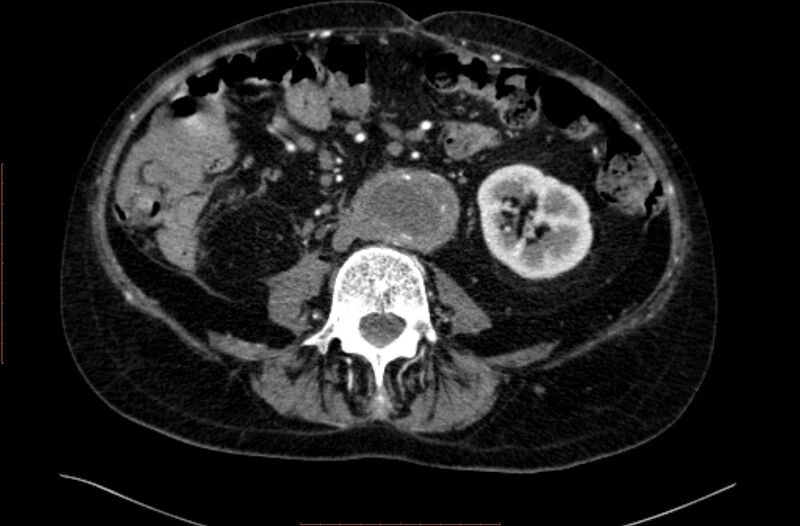 File:Abdominal aortic interposition tube graft and aneurysm thrombosis (Radiopaedia 71438-81857 Axial C+ arterial phase 98).jpg