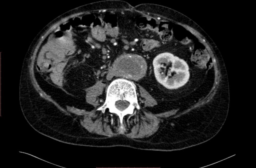 Abdominal aortic interposition tube graft and aneurysm thrombosis (Radiopaedia 71438-81857 Axial C+ arterial phase 98).jpg