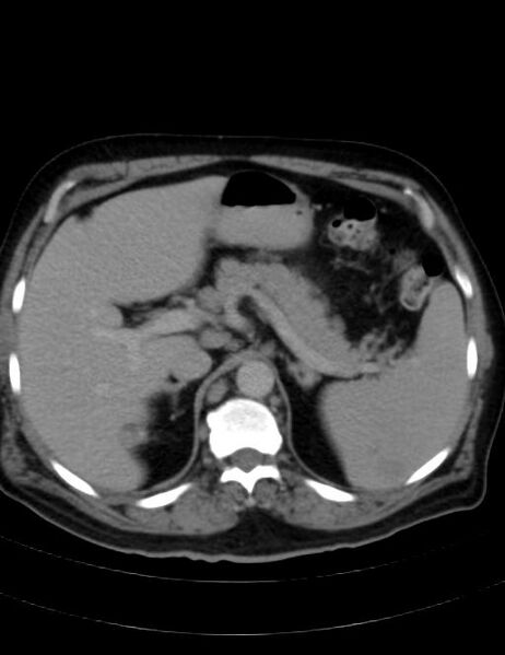 File:Abdominal lymphoma - with sandwich sign (Radiopaedia 53486-59492 Axial C+ portal venous phase 13).jpg