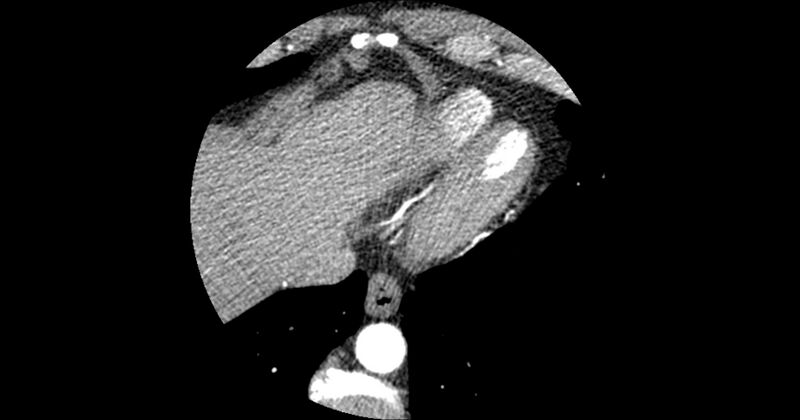 File:Aberrant left main coronary artery (ALMCA) arising from the right sinus with interarterial course (Radiopaedia 63251-71814 Axial C+ arterial phase 177).JPG