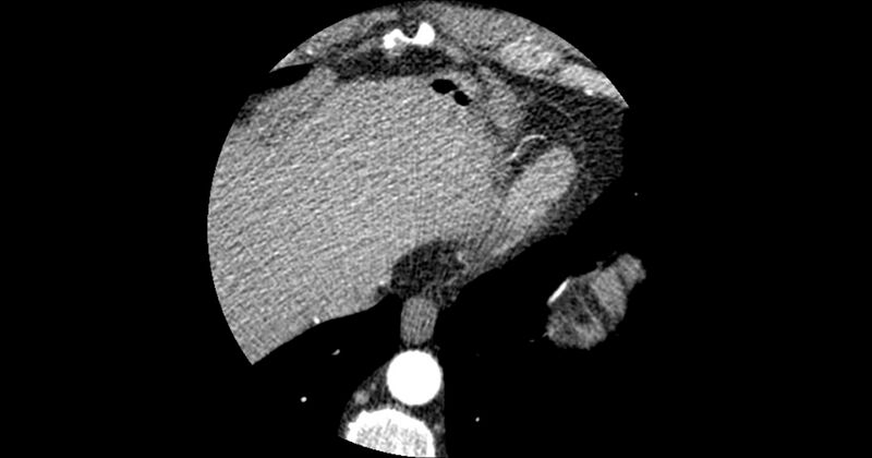 File:Aberrant left main coronary artery (ALMCA) arising from the right sinus with interarterial course (Radiopaedia 63251-71814 Axial C+ arterial phase 185).JPG