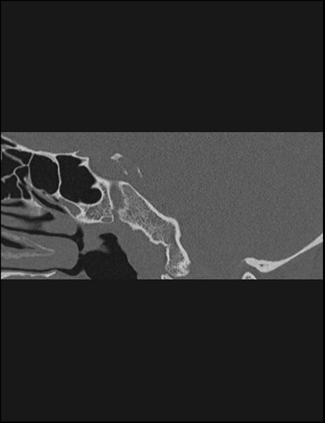 File:Aberrant right internal carotid artery (Radiopaedia 65191-74198 Sagittal non-contrast 90).jpg