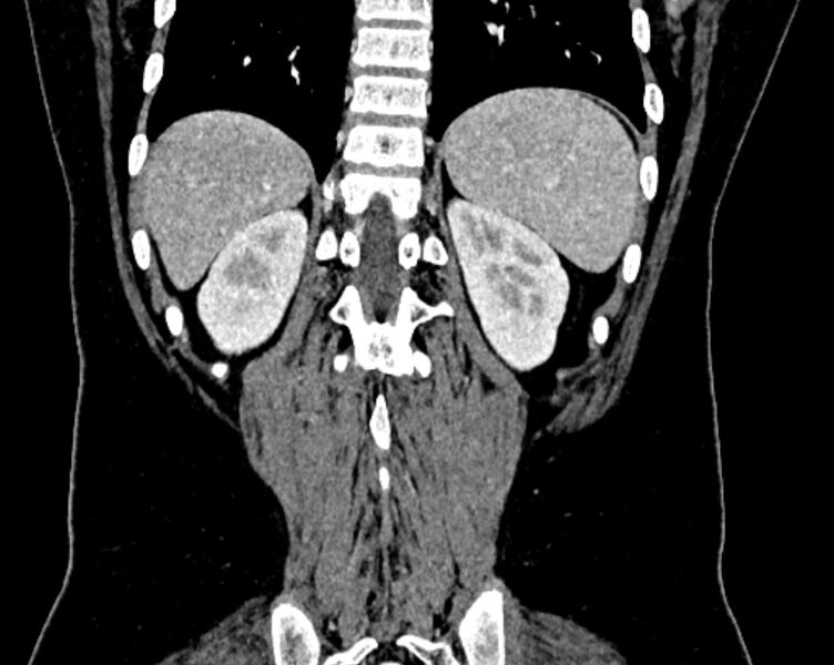 File:Accessory right inferior hepatic vein (Radiopaedia 75207-86305 Coronal C+ portal venous phase 65).jpg