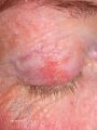 Actinic Keratoses treated with imiquimod (DermNet NZ lesions-ak-imiquimod-3761).jpg