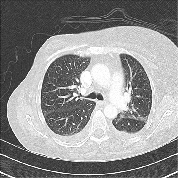 File:Acute-on-chronic pulmonary emboli (Radiopaedia 27925-28169 lung window 18).jpg