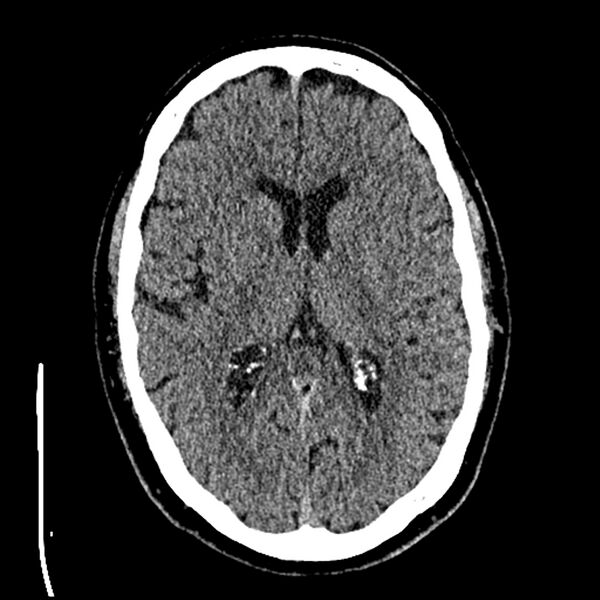 File:Acute A3 occlusion with ACA ischemic penumbra (CT perfusion) (Radiopaedia 72036-82525 Axial non-contrast thins 41).jpg