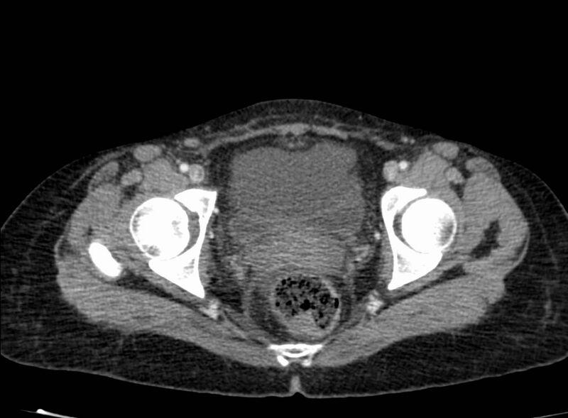 File:Acute Budd-Chiari syndrome (Radiopaedia 60858-68638 Axial C+ portal venous phase 280).jpg