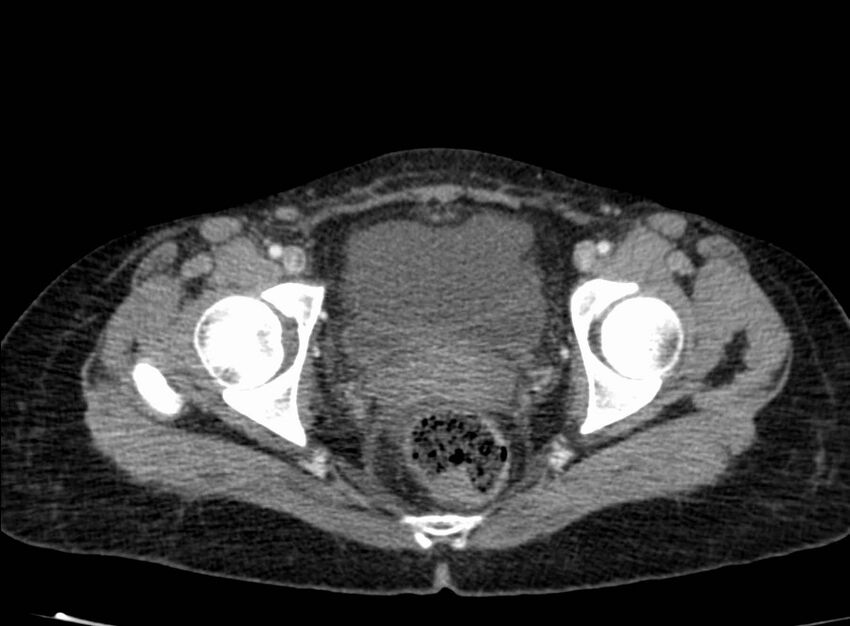 Acute Budd-Chiari syndrome (Radiopaedia 60858-68638 Axial C+ portal venous phase 280).jpg
