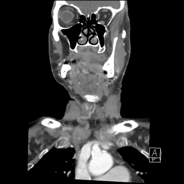 File:Acute ICA ischemic penumbra due to high-grade CCA stenosis (CT perfusion) (Radiopaedia 72038-82530 Coronal C+ arterial phase 7).jpg