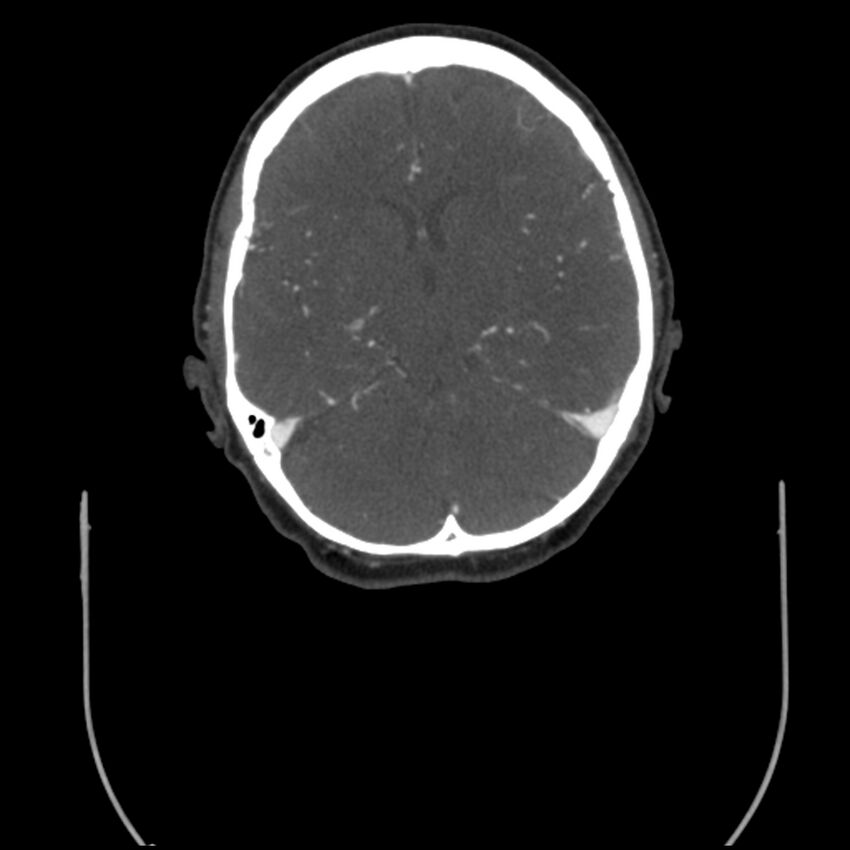 Acute M1 occlusion with ischemic penumbra (CT perfusion) (Radiopaedia 71897-82344 Axial C+ arterial phase thins 71).jpg