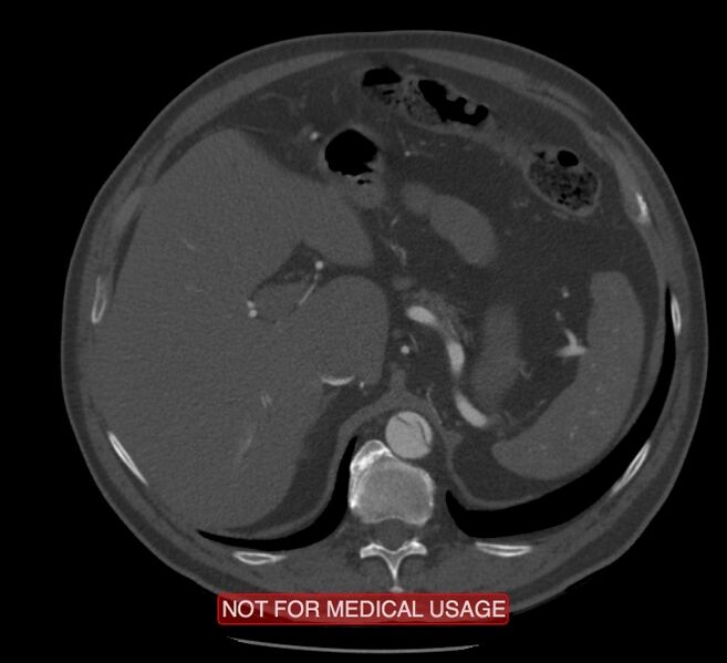 File:Acute aortic dissection - Stanford type A (Radiopaedia 40661-43285 Axial C+ arterial phase 80).jpg