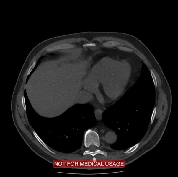 File:Acute aortic dissection - Stanford type A (Radiopaedia 40661-43285 Axial non-contrast 53).jpg