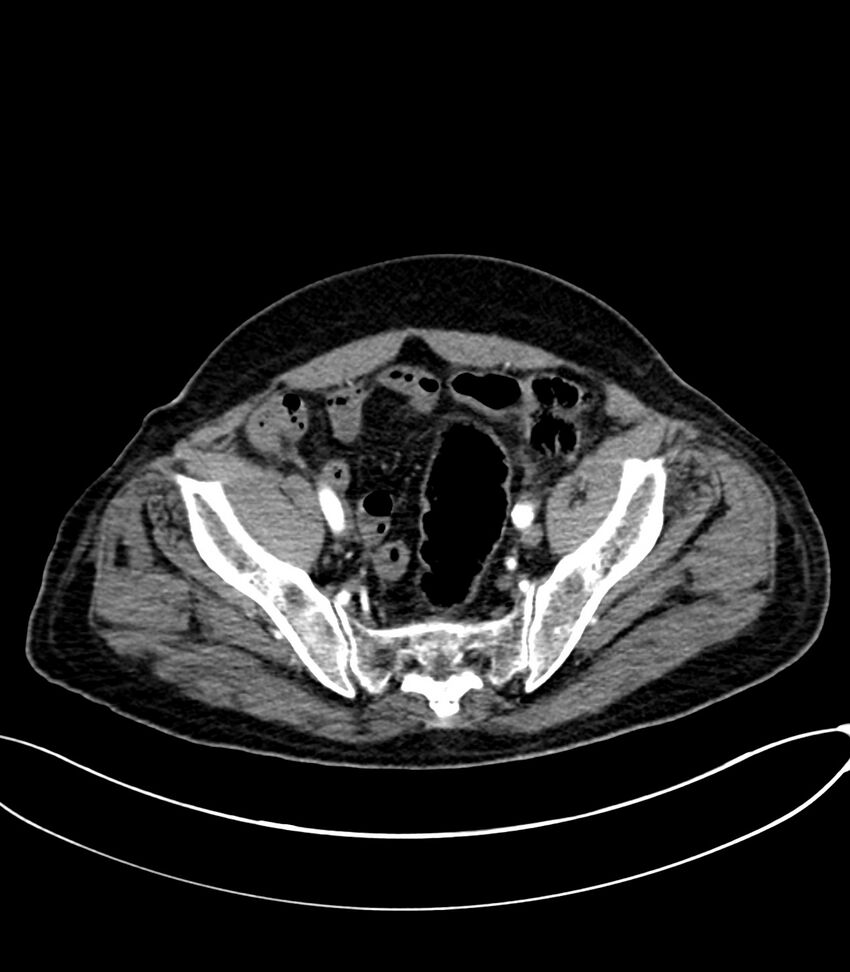 Acute arterial mesenteric ischemia (Radiopaedia 78238-90828 Axial C+ arterial phase 117).jpg