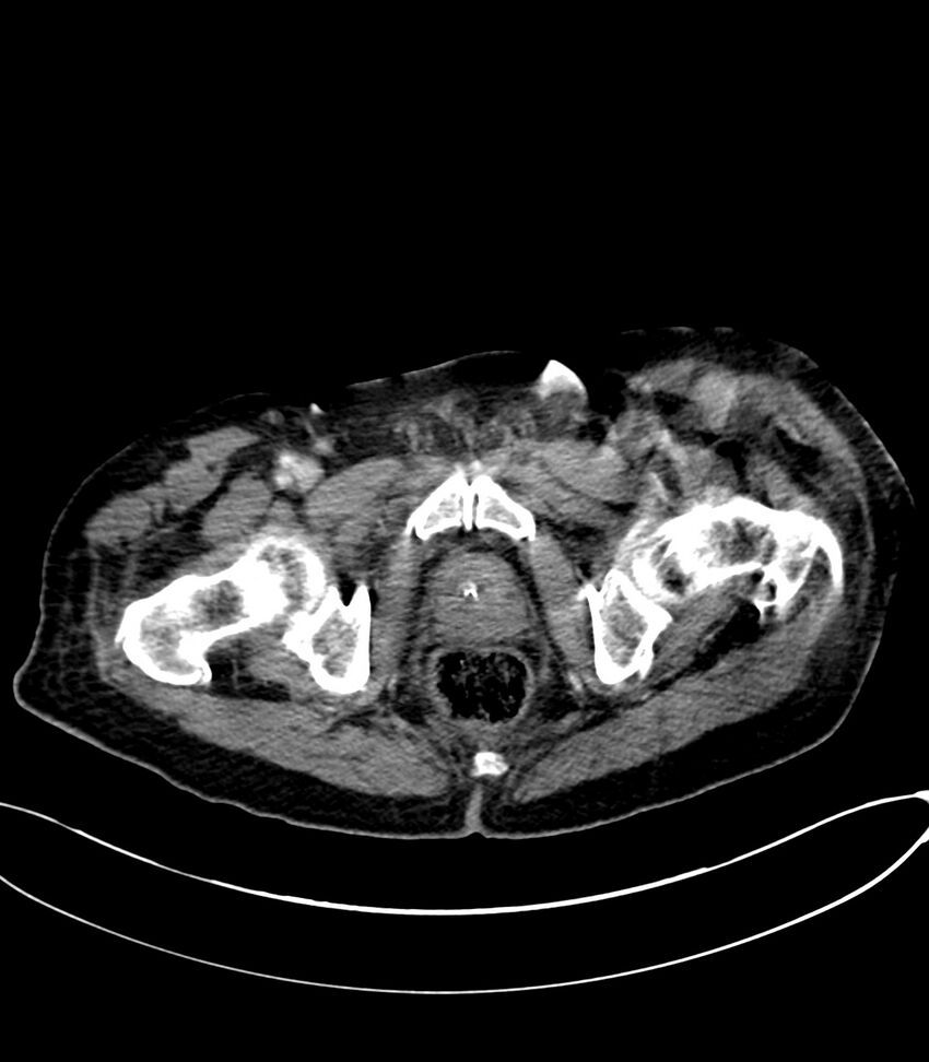 Acute arterial mesenteric ischemia (Radiopaedia 78238-90828 Axial C+ portal venous phase 142).jpg