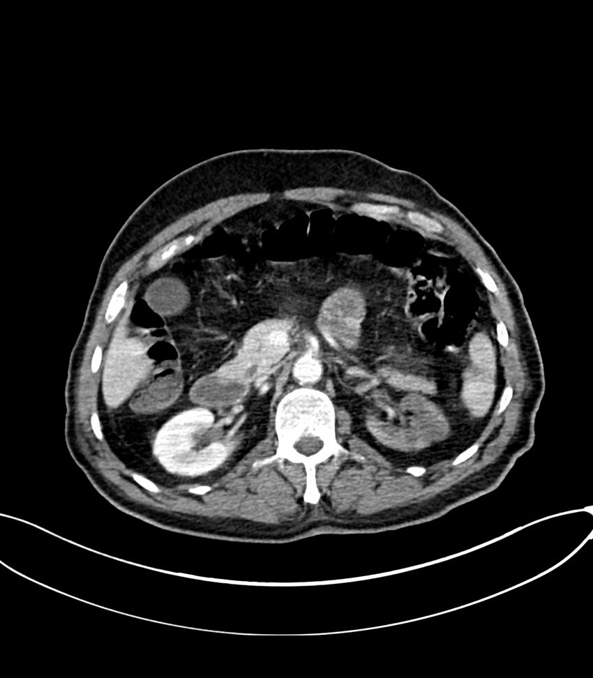 Acute arterial mesenteric ischemia (Radiopaedia 78238-90828 Axial C+ portal venous phase 50).jpg
