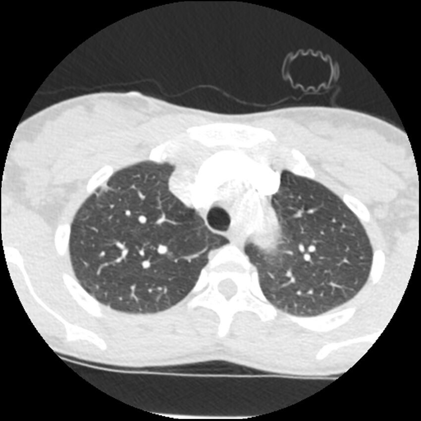 Acute chest syndrome - sickle cell disease (Radiopaedia 42375-45499 Axial lung window 48).jpg