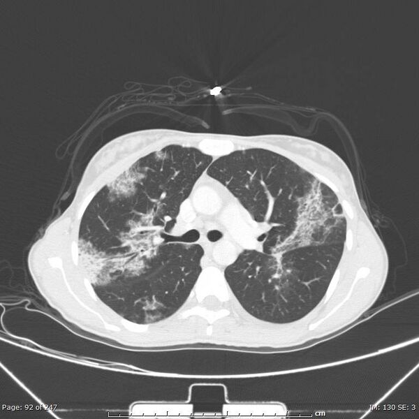 File:Acute eosinophilic pneumonia (Radiopaedia 48211-53073 Axial lung window 33).jpg