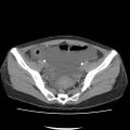 Acute myocarditis (Radiopaedia 55988-62613 Axial C+ portal venous phase 64).jpg