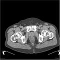 Acute pancreatitis (Radiopaedia 19135-19116 Axial non-contrast 58).jpg
