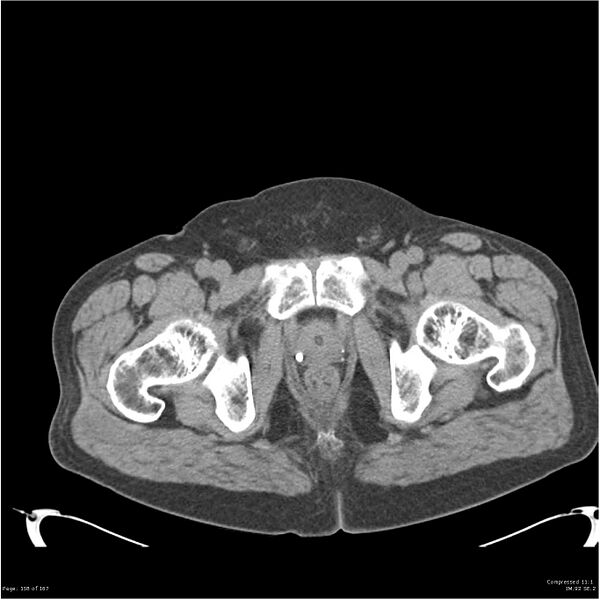 File:Acute pancreatitis (Radiopaedia 19135-19116 Axial non-contrast 58).jpg