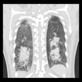 Acute pulmonary edema on CT (Radiopaedia 33582-34672 Coronal lung window 31).jpg
