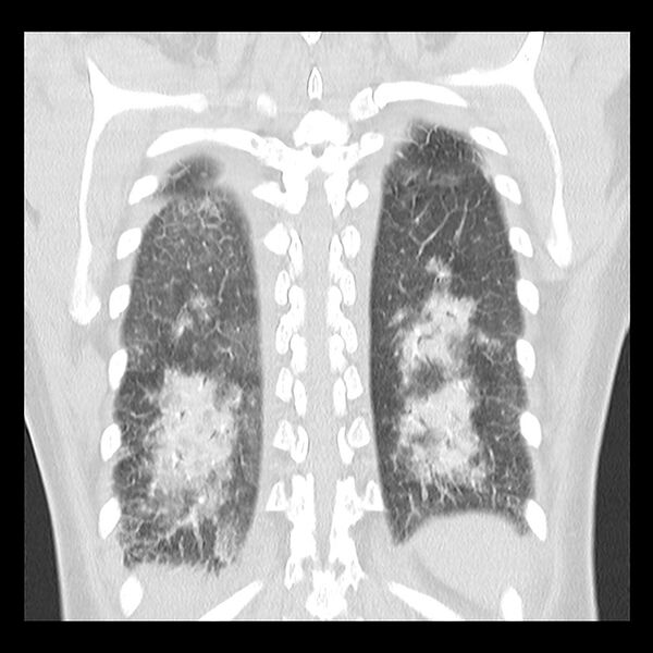File:Acute pulmonary edema on CT (Radiopaedia 33582-34672 Coronal lung window 31).jpg