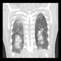 Acute pulmonary edema on CT (Radiopaedia 33582-34672 Coronal lung window 32).jpg