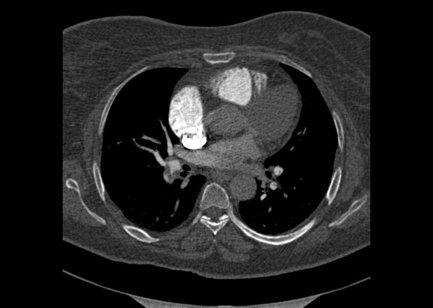 Acute pulmonary embolism (Radiopaedia 29938-30466 Axial C+ CTPA 98).jpg