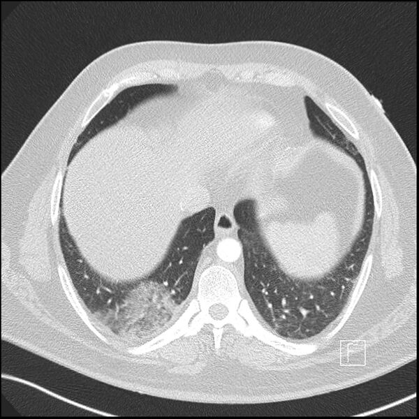 File:Acute pulmonary embolism with pulmonary infarct (Radiopaedia 73062-83768 Axial lung window 17).jpg