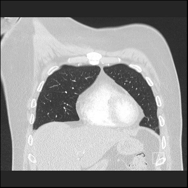 File:Acute pulmonary embolism with pulmonary infarct (Radiopaedia 73062-83768 Coronal lung window 18).jpg