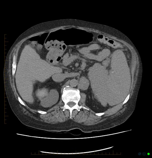 File:Acute renal failure post IV contrast injection- CT findings (Radiopaedia 47815-52557 Axial non-contrast 28).jpg