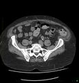 Acute renal failure post IV contrast injection- CT findings (Radiopaedia 47815-52557 Axial non-contrast 59).jpg