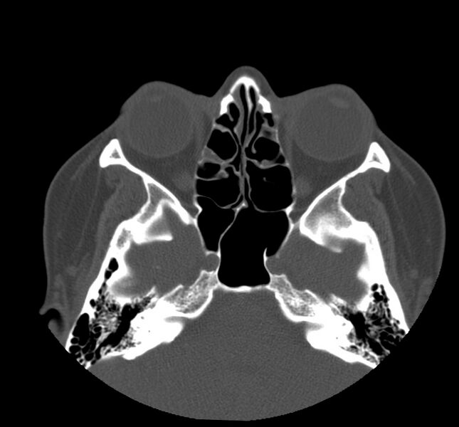 File:Acute sinusitis (Radiopaedia 22419-22455 Axial non-contrast 19).jpg