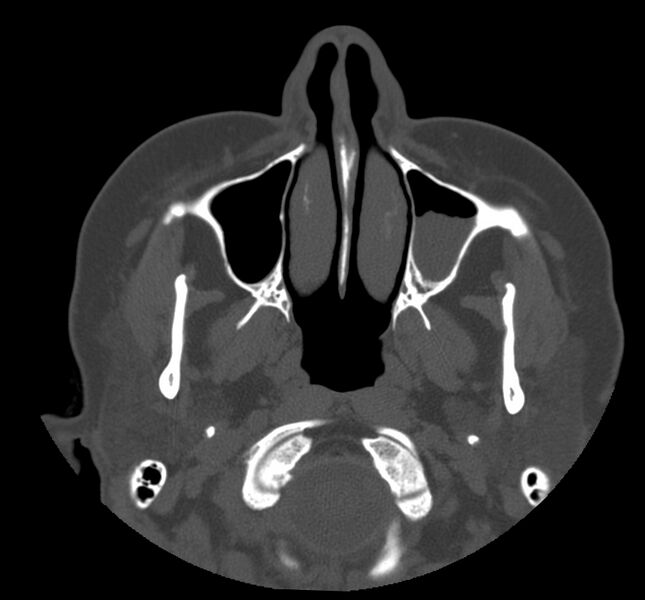 File:Acute sinusitis (Radiopaedia 22419-22455 Axial non-contrast 7).jpg