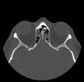 Acute sinusitis (Radiopaedia 23161-23215 Axial bone window 53).jpg