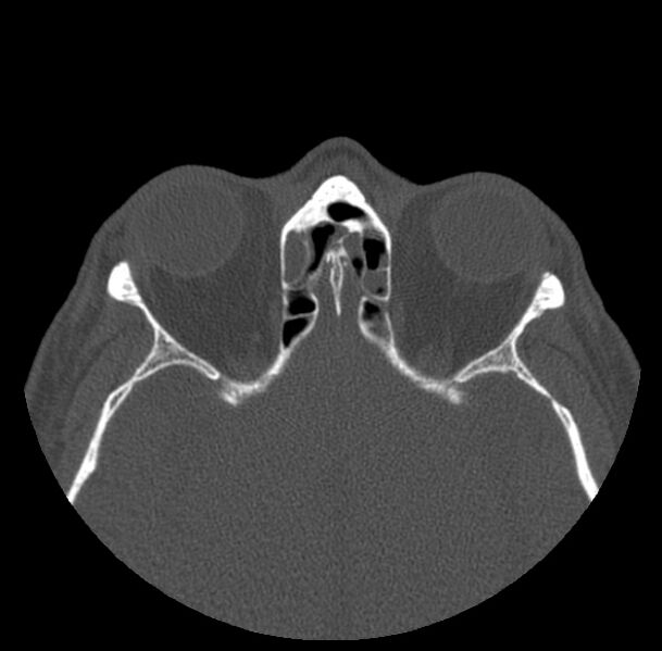 File:Acute sinusitis (Radiopaedia 23161-23215 Axial bone window 53).jpg