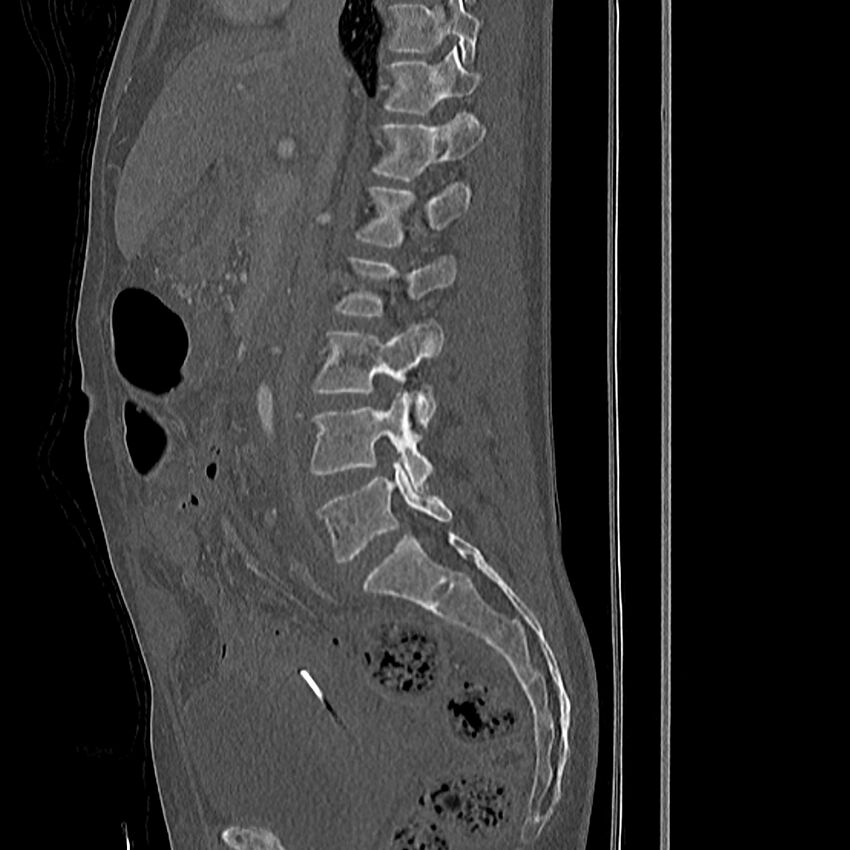 Acute vertebral body compression fractures (Radiopaedia 31757-32693 Sagittal bone window 33).jpg