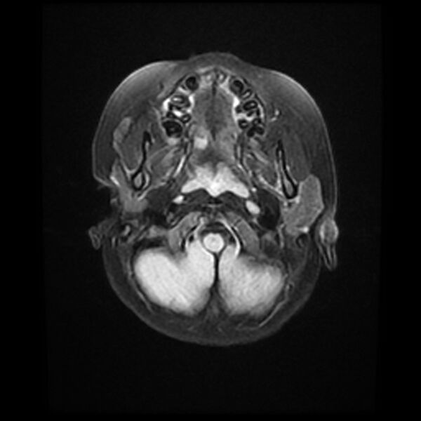 File:Adamantinomatous craniopharyngioma (Radiopaedia 77407-89529 Axial FLAIR 3).jpg