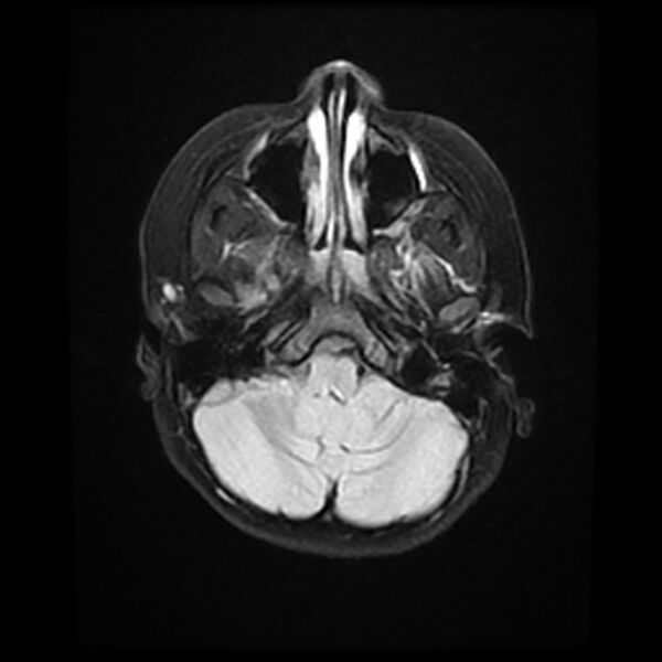 File:Adamantinomatous craniopharyngioma (Radiopaedia 77407-89529 Axial FLAIR 5).jpg
