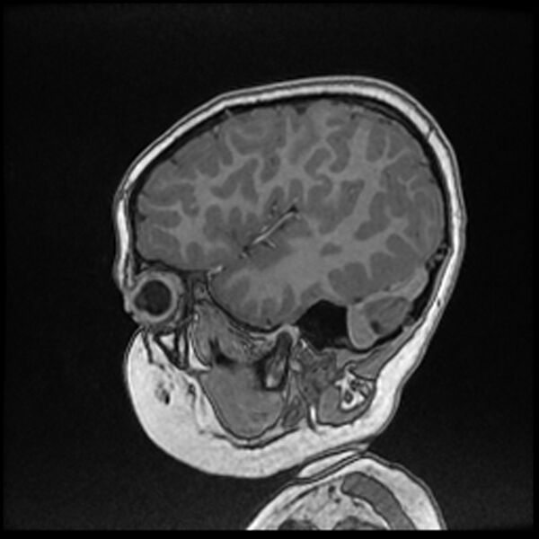 File:Adamantinomatous craniopharyngioma (Radiopaedia 77407-89529 Sagittal T1 C+ 29).jpg