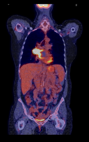 File:Adenocarcinoma of the lung (Radiopaedia 44205-47804 CORONAL PET-CT 1).png