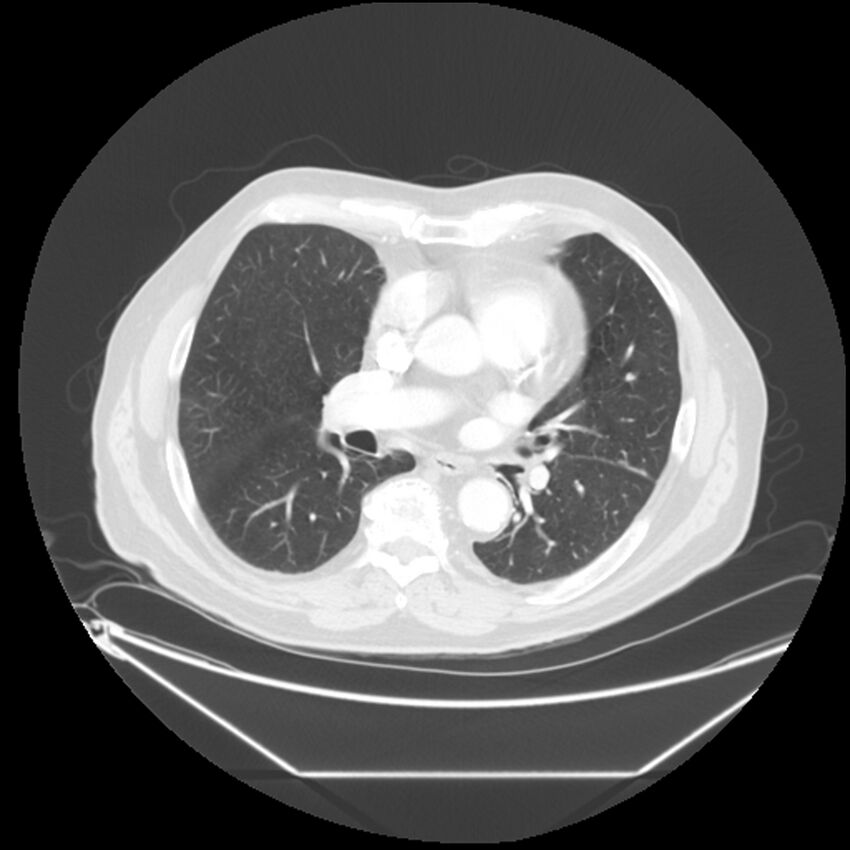 Adenocarcinoma of the lung (Radiopaedia 44876-48759 Axial lung window 41).jpg