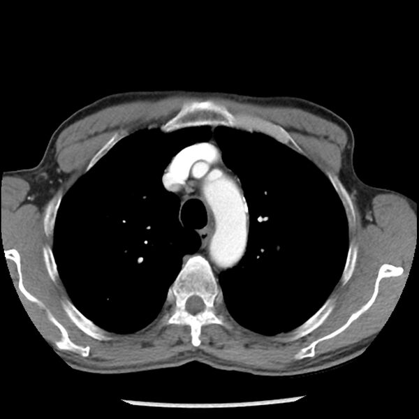File:Adenocarcinoma of the lung - micropapillary predominant (Radiopaedia 42446-45563 Axial C+ portal venous phase 19).jpg