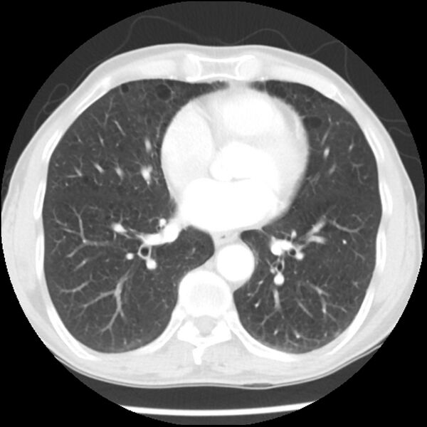 File:Adenocarcinoma of the lung - micropapillary predominant (Radiopaedia 42446-45563 Axial lung window 46).jpg