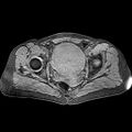 Adenomyoma of the uterus (huge) (Radiopaedia 9870-10438 Axial T1 fat sat 12).jpg