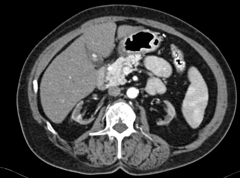 File:Adenomyomatosis of the gallbladder (Radiopaedia 12142-12483 Axial C+ arterial phase 11).jpg