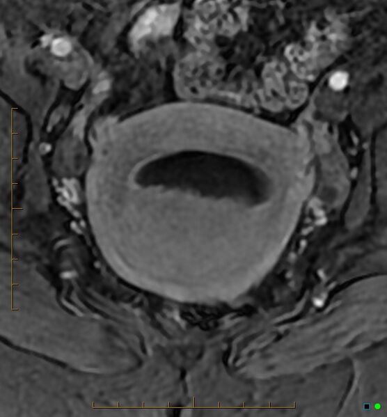 File:Adenomyosis uterus with hematometra (Radiopaedia 45779-50011 Axial T1 C+ fat sat 32).jpg