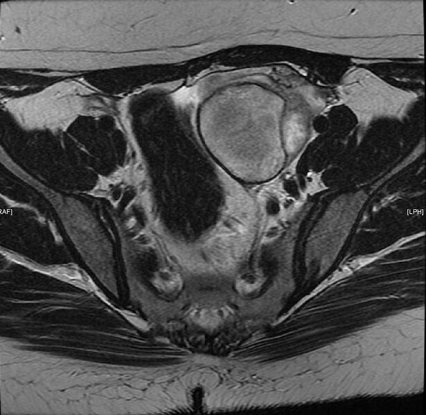 File:Adenomyosis with endometrioma (Radiopaedia 6753-7952 Axial T2 1).jpg