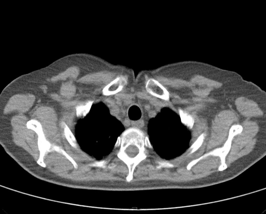 Adenosquamous lung carcinoma (Radiopaedia 22035-22030 non-contrast 15).jpg